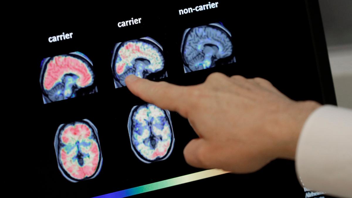 Den amerikanska läkemedelsmyndigheten FDA har gett svenska Bioarctics antikropp lecanemab, för behandling av Alzheimers sjukdom, så kallad Fast Track designation