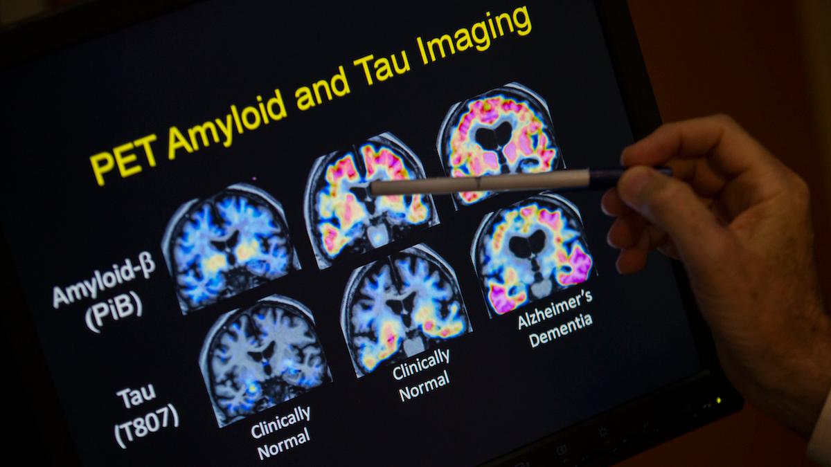 Forskare har upptäckt en gen kallad MGMT och den kan vara förklaringen till varför kvinnor diagnostiseras med Alzheimers oftare än män