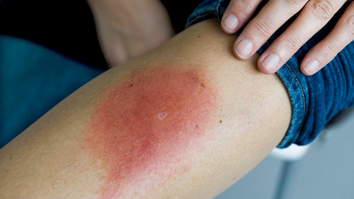 Läkemedelstillverkaren Valneva utvecklar ett vaccin mot borrelia och ska inleda test på människor om några veckor. Vissa som infekteras får typiska utslag, men inte alla, varför en del upptäcker att de smittas först efter en tid då standardbehandling med antibiotika kan vara ineffektiv.