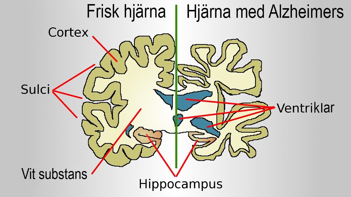 Ansökan om marknadsgodkännande för ett svenskutvecklat läkemedel mot Alzheimers har tilldelats prioriterad granskning av Kinas läkemedelsmyndighet