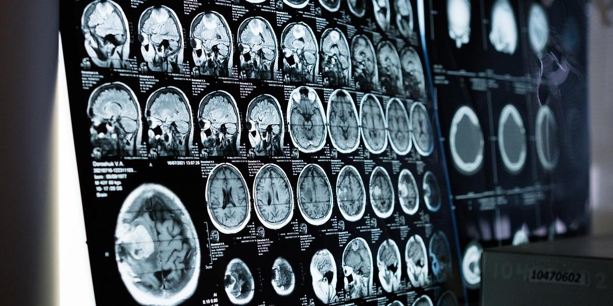 Ett gammalt vaccin mot tuberkulos, TB, minskar risken för flera infektioner och testas nu även mot Alzheimers sjukdom