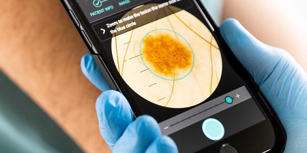 Enligt en ny svensk studie, som publicerats i British Journal of Dermatology, diagnosticerar AI-verktyget Dermalyser malignt melanom men väldigt hög precision