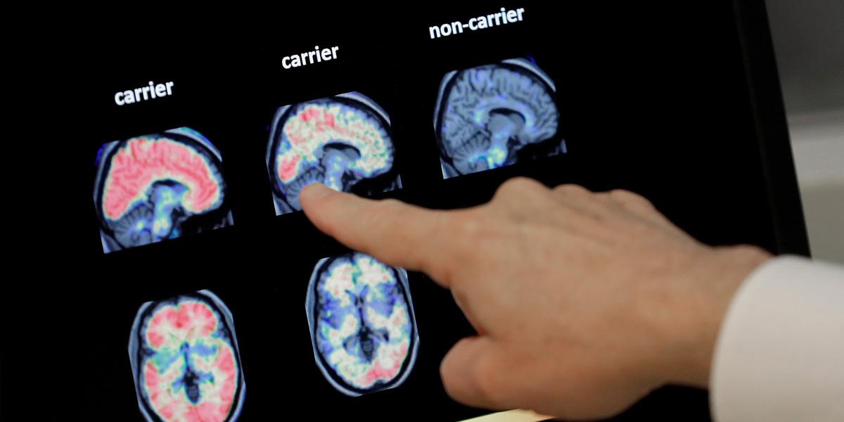 Alzheimers sjukdom