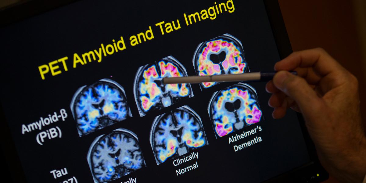 Ny forskning visar att inflammation från magfett kan vara kopplad till tidiga stadier av Alzheimers sjukdom, flera decennier innan symtomen börjar